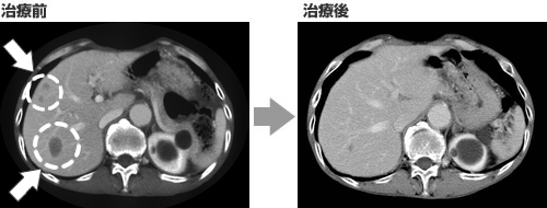 直腸がん→肝臓へ転移